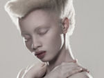 Portrait Series Highlights Beauty of Albinism, Birthmarks & Other Skin  Conditions